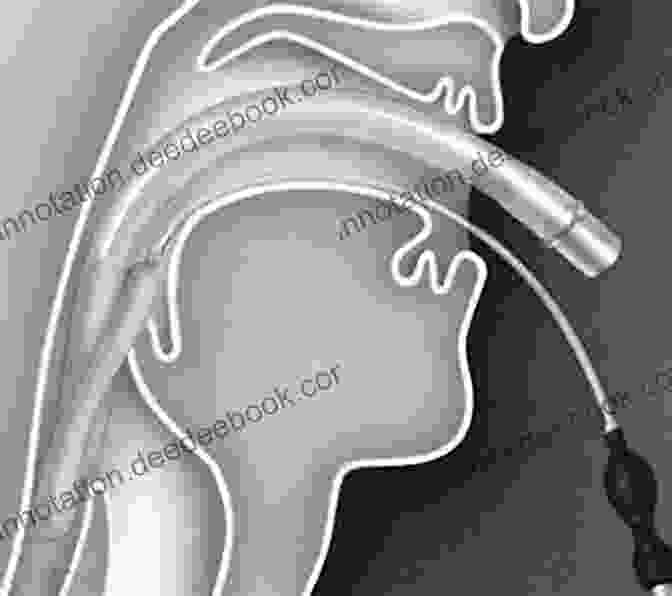 Laryngeal Mask Image Showing Its Placement In The Airway An Update On Airway Management (Recent Advances In Anesthesiology 3)